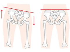 骨盤調整について